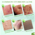 Acne Treatment Repair Aloe Vera Gel Skin Care